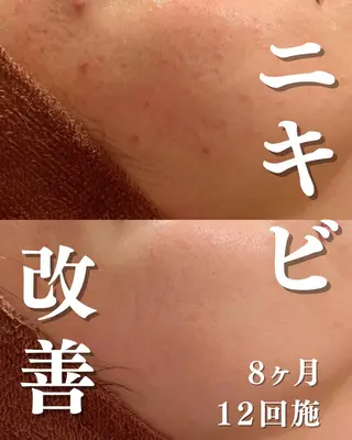🔥3か月で肌革命 🔥ニキビ専門店のエステ・リラクイメージ