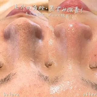 【ハーブピーリング/毛穴洗浄】NA skin 川崎店〜ニキビ・毛穴専門店〜所属・NAホワイトニング 川崎店のエステ・リラクイメージ