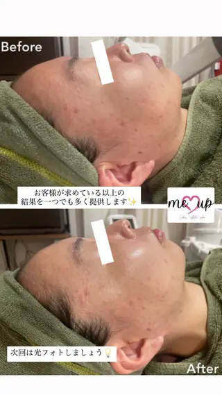 Meupニキビ専門店 背中/ハーブ/ララのその他イメージ