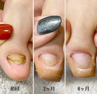 ネイル 深爪・巻き爪 専門サンセリテのネイルデザイン