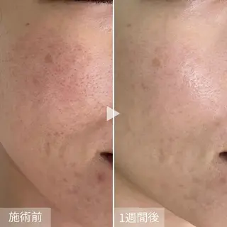 シェノン所属・ニキビ・毛穴改善 専門サロンのエステ・リラクイメージ