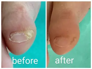 巻き爪補正店 大阪なんば店のネイルデザイン