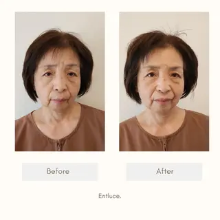 即効⚡小顔美容鍼🪡 むくみたるみ脂肪解消のエステ・リラクイメージ