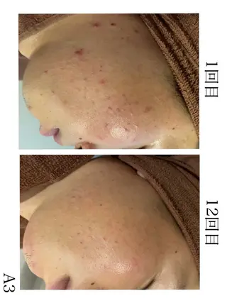 学生ニキビ改善🍀 優しい肌質改善のエステ・リラクイメージ