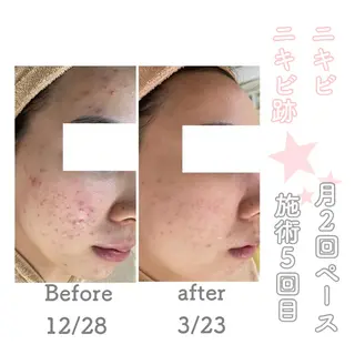 ショート カラー パーマ ヘアアレンジ メンズ キッズ ネイル マツエク・マツパ ニキビ&跡改善サロン オーナー光木のエステ・リラクイメージ