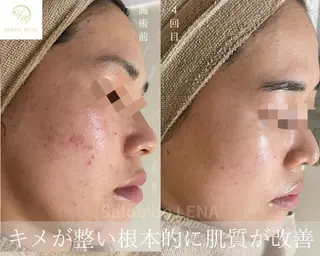 ハーブピーリング・毛穴ケア専門サロンSalon de LENA 栄店所属・ハーブピーリング専門 サロンドレナ　白藤のエステ・リラクイメージ