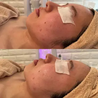 毛穴ケア/毛穴診断/ 毛穴洗浄〔心斎橋〕のエステ・リラクイメージ