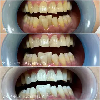 ネイル/耳つぼ /新ホワイトニングのネイルデザイン