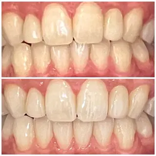 ミディアム 💎ダイヤモンド ホワイトニング渋谷のその他イメージ