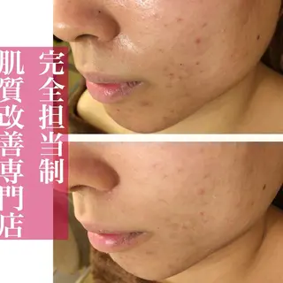 学生ニキビ改善🍀 優しい肌質改善のエステ・リラクイメージ