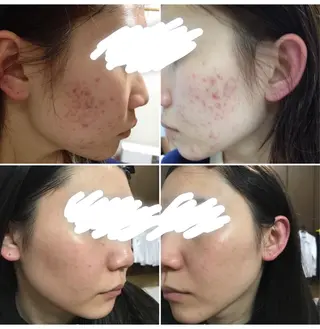 ミディアム カラー パーマ ヘアアレンジ メンズ キッズ ネイル マツエク・マツパ ニキビ&跡改善サロン オーナー光木のエステ・リラクイメージ