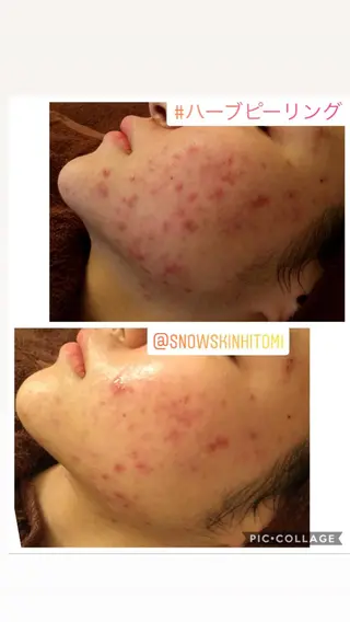 ニキビ/肌質改善専門 Snow skinのエステ・リラクイメージ