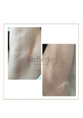 キッズ 脱毛/美肌【皮膚科看 護師経営】ラベニールのエステ・リラクイメージ