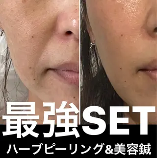 つばさ所属・マッツンの 鍼のその他イメージ
