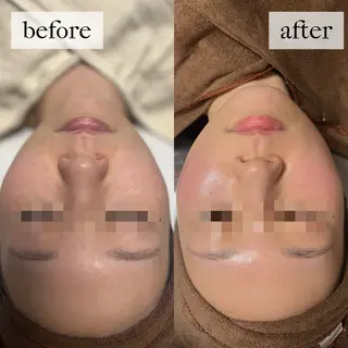 HINANO矢場町店【ヒナノ】所属・脱毛/肌改善🌿 HINANO 村田のエステ・リラクイメージ