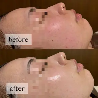 HINANO矢場町店【ヒナノ】所属・脱毛/肌改善🌿 HINANO 村田のエステ・リラクイメージ