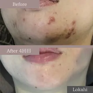 Lokahi所属・脱毛/エステ/水光肌 Lokahiのエステ・リラクイメージ