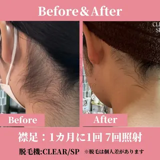 メンズ キッズ 有人型セルフサロン 脱毛/痩身/美顔のその他イメージ