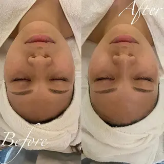 毛穴/ピーリング ララピール/POLAのエステ・リラクイメージ