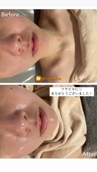 Meupニキビ専門店 背中/ハーブ/ララのその他イメージ