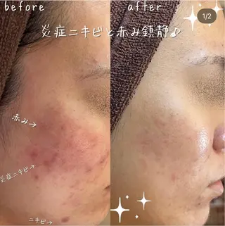 【ハーブピーリング/毛穴洗浄】NA skin 川崎店〜ニキビ・毛穴専門店〜所属・NAskin川崎 皆川のエステ・リラクイメージ