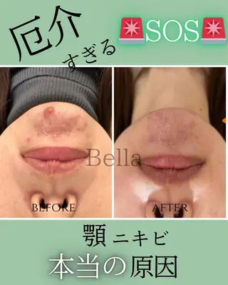 肌質改善ハーブ ピーリングBellaのエステ・リラクイメージ