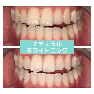 ホワイトニング|韓国式3D毛穴洗浄 lonhana ロンハナ所属・韓国式3D毛穴洗浄 lonhanaのその他イメージ