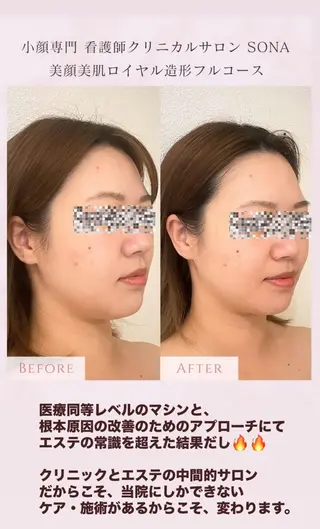 小顔/たるみ/黒ずみ除去専門サロン/SONA 大和西大寺店所属・【小顔専門看護師 サロンSONA】のエステ・リラクイメージ