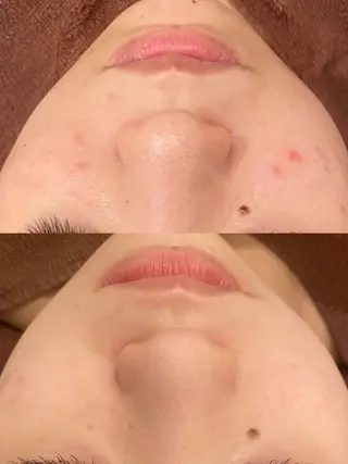 🔥3か月で肌革命 🔥ニキビ専門店のエステ・リラクイメージ