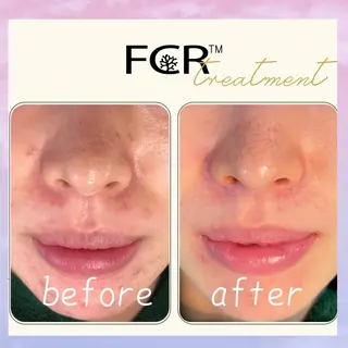 肌質改善Charme coco  みさのエステ・リラクイメージ