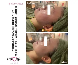 Meupニキビ専門店 背中/ハーブ/ララのその他イメージ