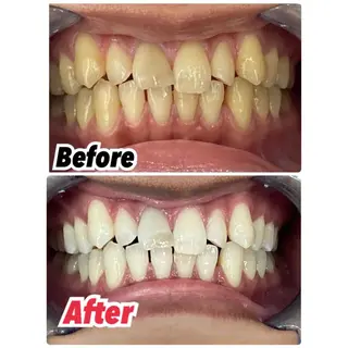 キッズ ネイル アイブロウ プラチナムビューティー柏所属・【歯科提携】柏ホワイ トニングスタイルのその他イメージ