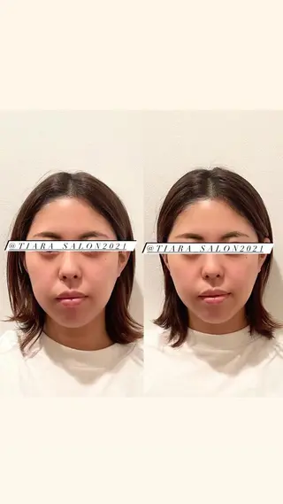 美容鍼灸サロン　TIARA所属・鍼灸サロン TIARA　美容鍼のエステ・リラクイメージ