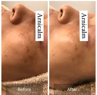 ハーブピーリング 肌再生ピーリング/のエステ・リラクイメージ