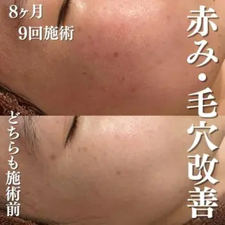 ダウンタイムなし✨ 敏感肌さん用エステのエステ・リラクイメージ