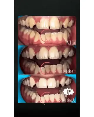 歯のセルフホワイトニング専門店GLOW(グロウ)所属・東区香椎歯のセルフホ ワイトニングGLOWのその他イメージ