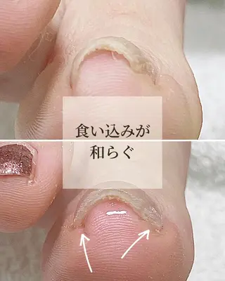 ネイル 深爪・巻き爪 専門サンセリテのネイルデザイン