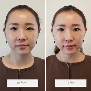 即効⚡小顔美容鍼🪡 むくみたるみ脂肪解消のエステ・リラクイメージ