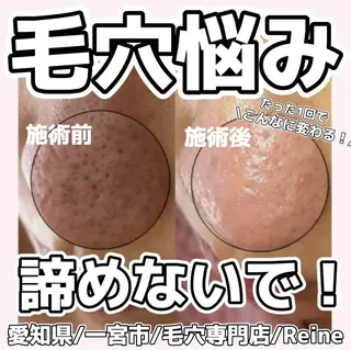 Reine BeautySalon所属・毛穴/シミ肝斑/脱毛 横山梨里のエステ・リラクイメージ