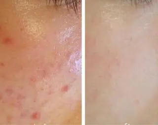 ☺ハーブピール💕 ソフィアカロン💖のエステ・リラクイメージ