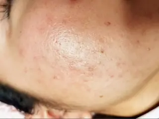 ☺ハーブピール💕 ソフィアカロン💖のエステ・リラクイメージ