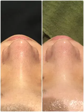 【リベルハーブピーリング認定店】敏感肌・美白脱毛専門店Dione立川店所属・Dione 立川店のエステ・リラクイメージ