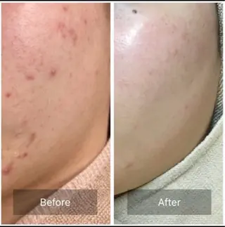 ハーブピーリング 専門店MOKA所属・ハーブピーリング専門 MOKAのエステ・リラクイメージ