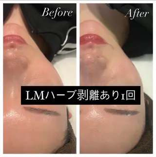 ハーブピーリング LIME池袋東口店のエステ・リラクイメージ