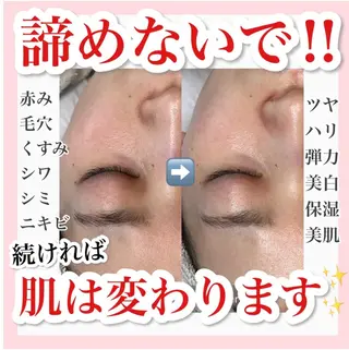 毛穴・ニキビケア・ハーブピーリング 肌管理専門店 WHITE AQUA 神戸三宮店所属・🌷あいり 🌷のエステ・リラクイメージ