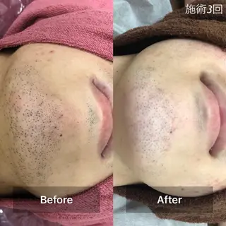 メンズ エステ.まつげ.小顔 眉毛.プラズマ.脱毛のマツエク・マツパデザイン