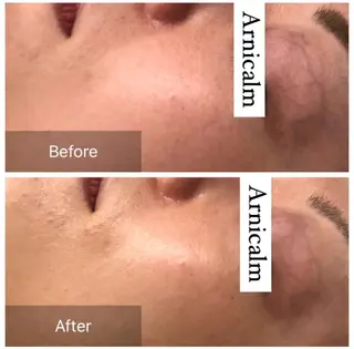 ハーブピーリング 肌再生ピーリング/のエステ・リラクイメージ