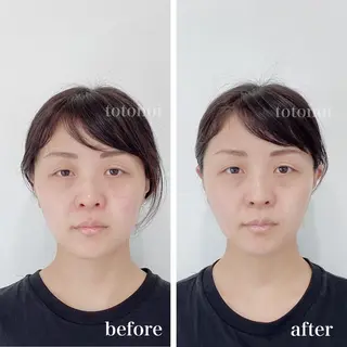 はり灸サロン　totonoi所属・筋膜リリース 小顔美容鍼のエステ・リラクイメージ