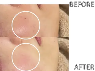 ハーブピーリング LIME池袋東口のエステ・リラクイメージ