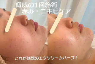 最速小顔・肌質管理 ❣️エスポワールのエステ・リラクイメージ